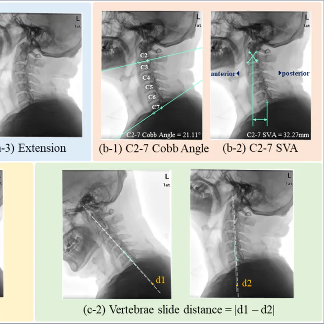 [Research Paper] Knowledge-Guided Gated Multitasking Network for Cervical Spine Degeneration Evaluation